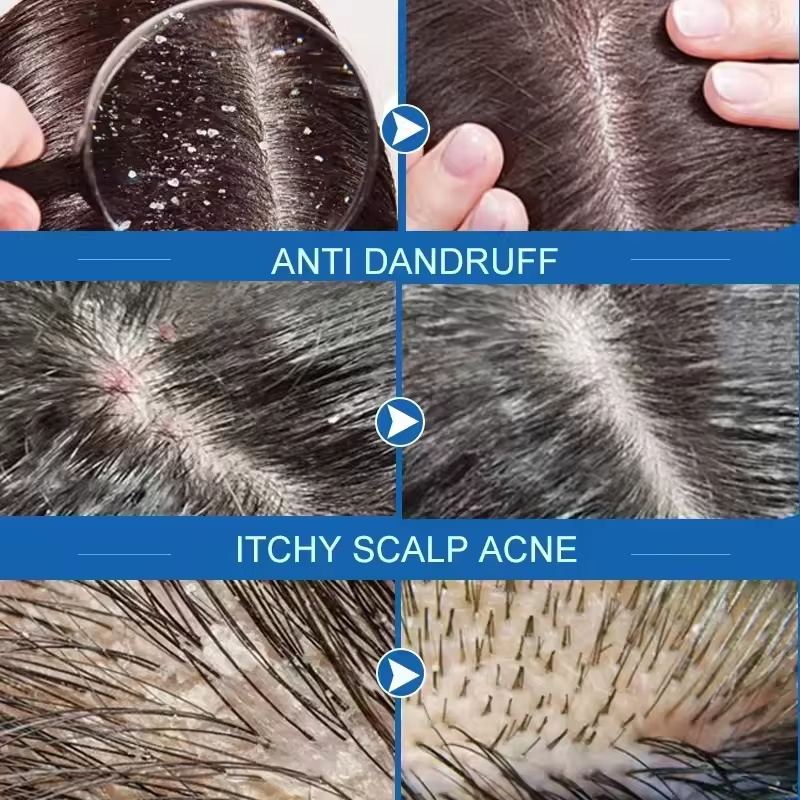 Fast Anti Dandruff Hair Treatm - Castor Oil Soap recension och pris